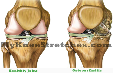 Arthritis in the Knee