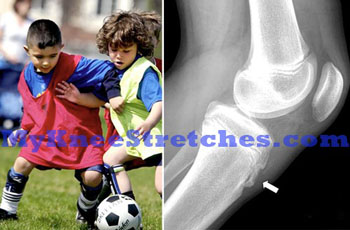 Knee Pain in Children